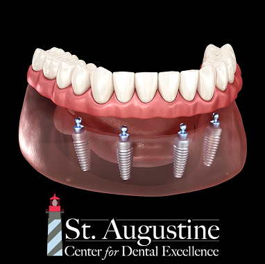 Zirconia Implant Bridge