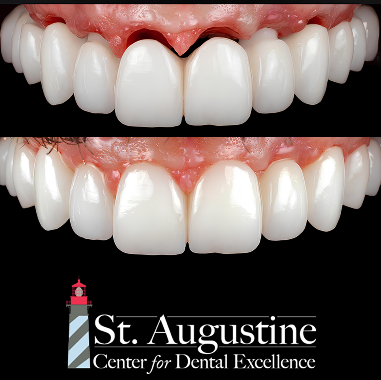 Porcelain Implant Bridge